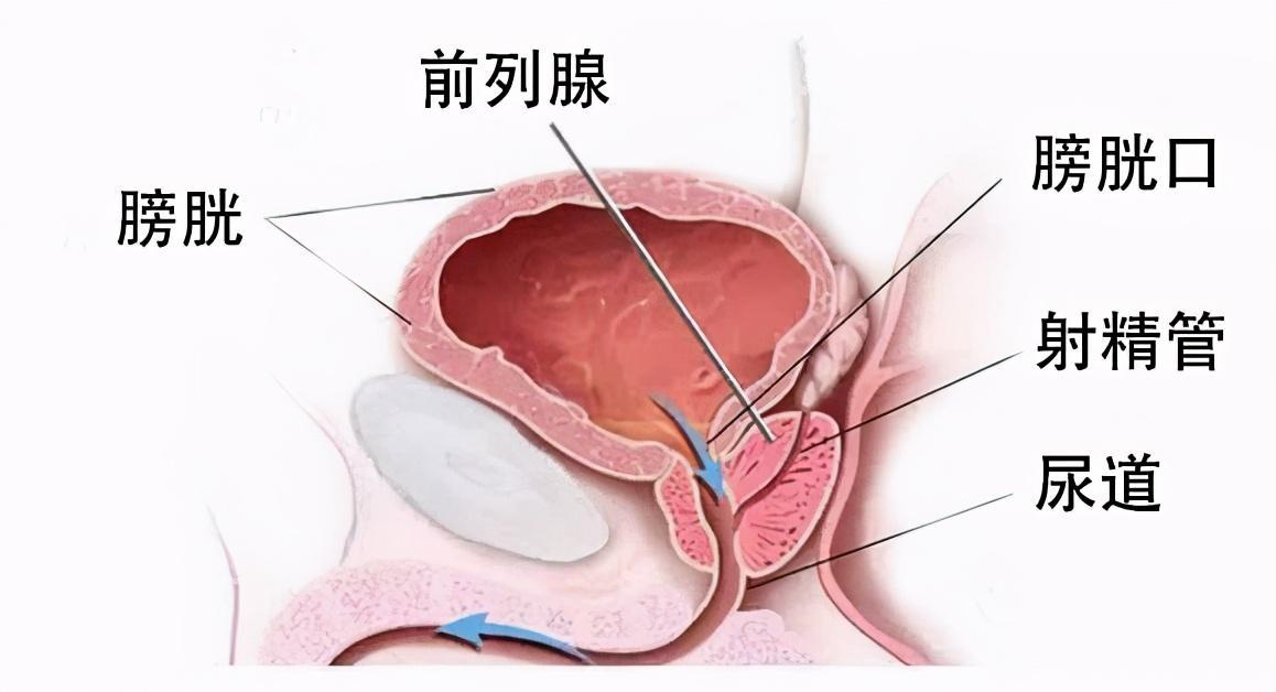 前列腺炎能好嗎？全面解析前列腺炎的治療與康復，全面解析前列腺炎治療與康復，能否痊愈？